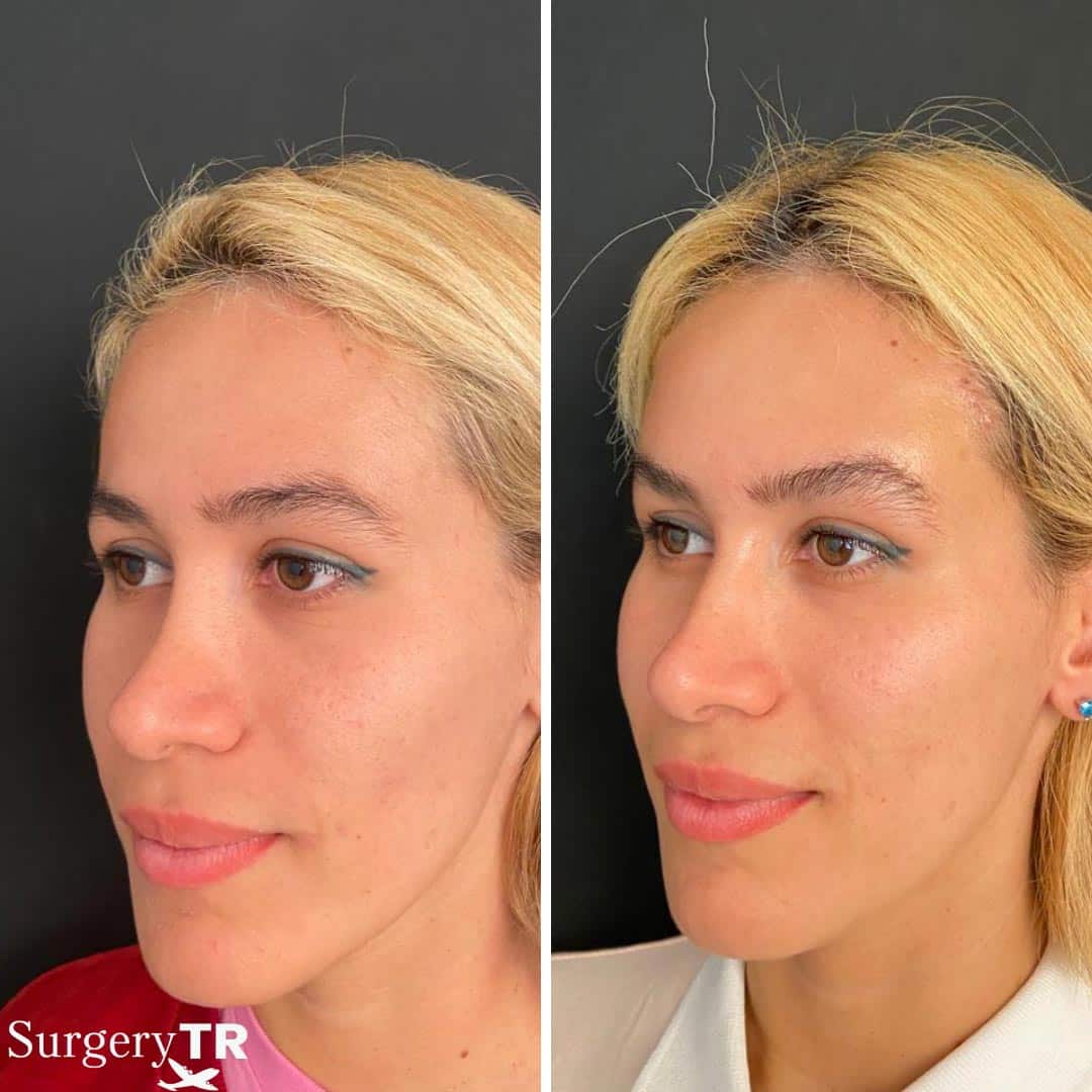 BrownLift Before After2
