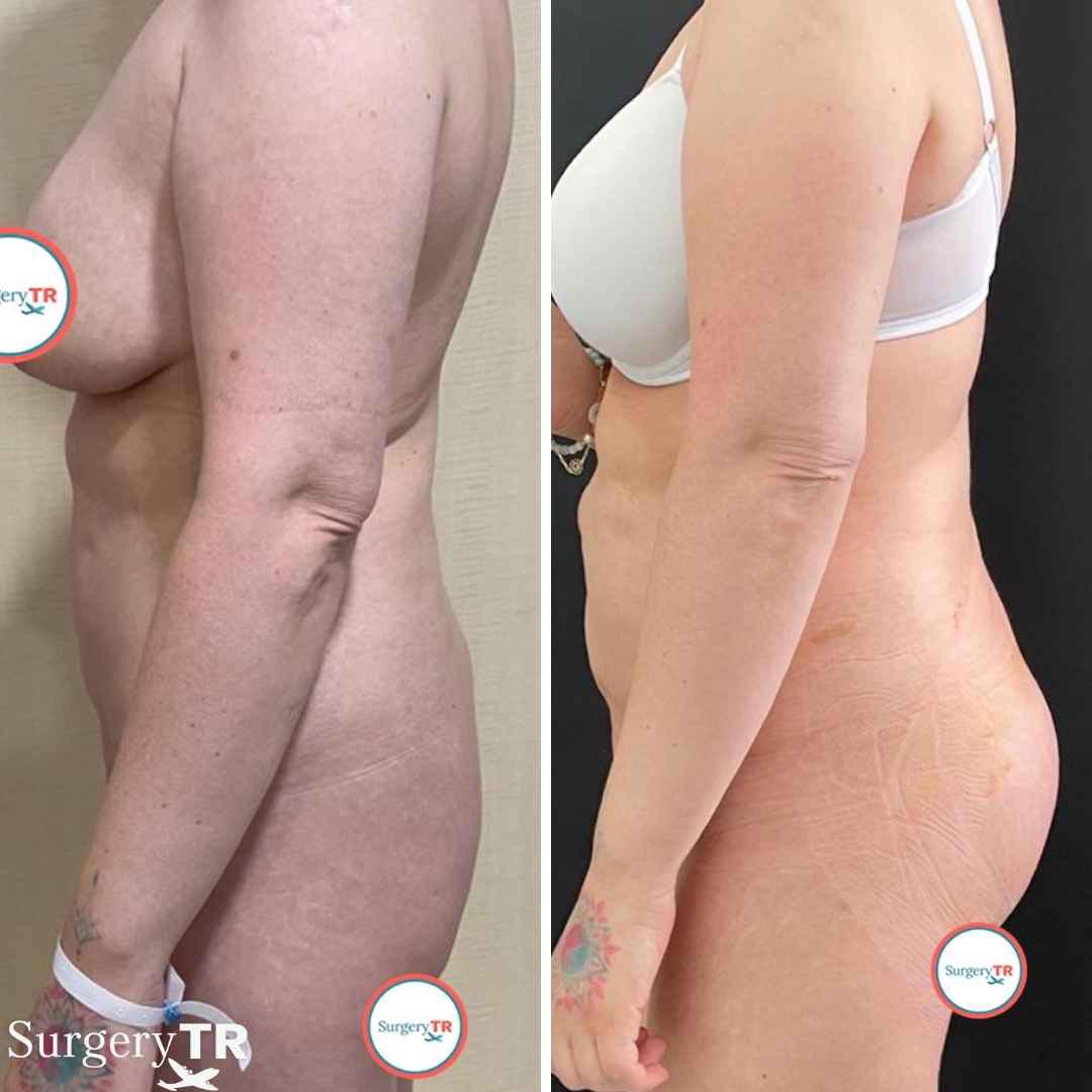 Butt Implant BeforeAfter 2