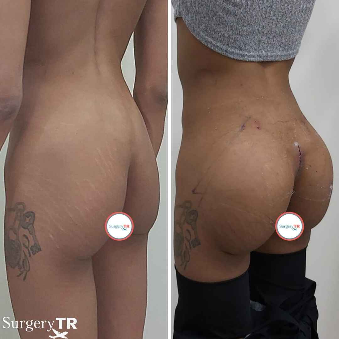 Butt Implant Revize1