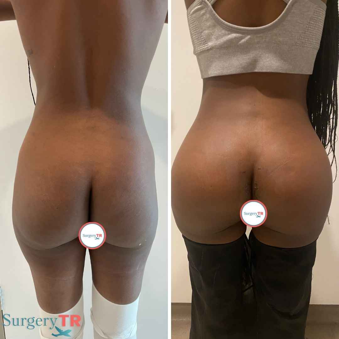 Butt Implant Revize2