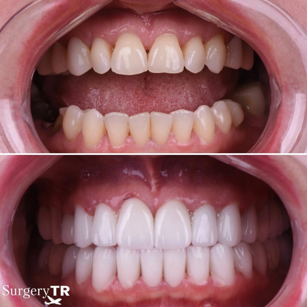 Antes y después de Sonrisa Hollywood