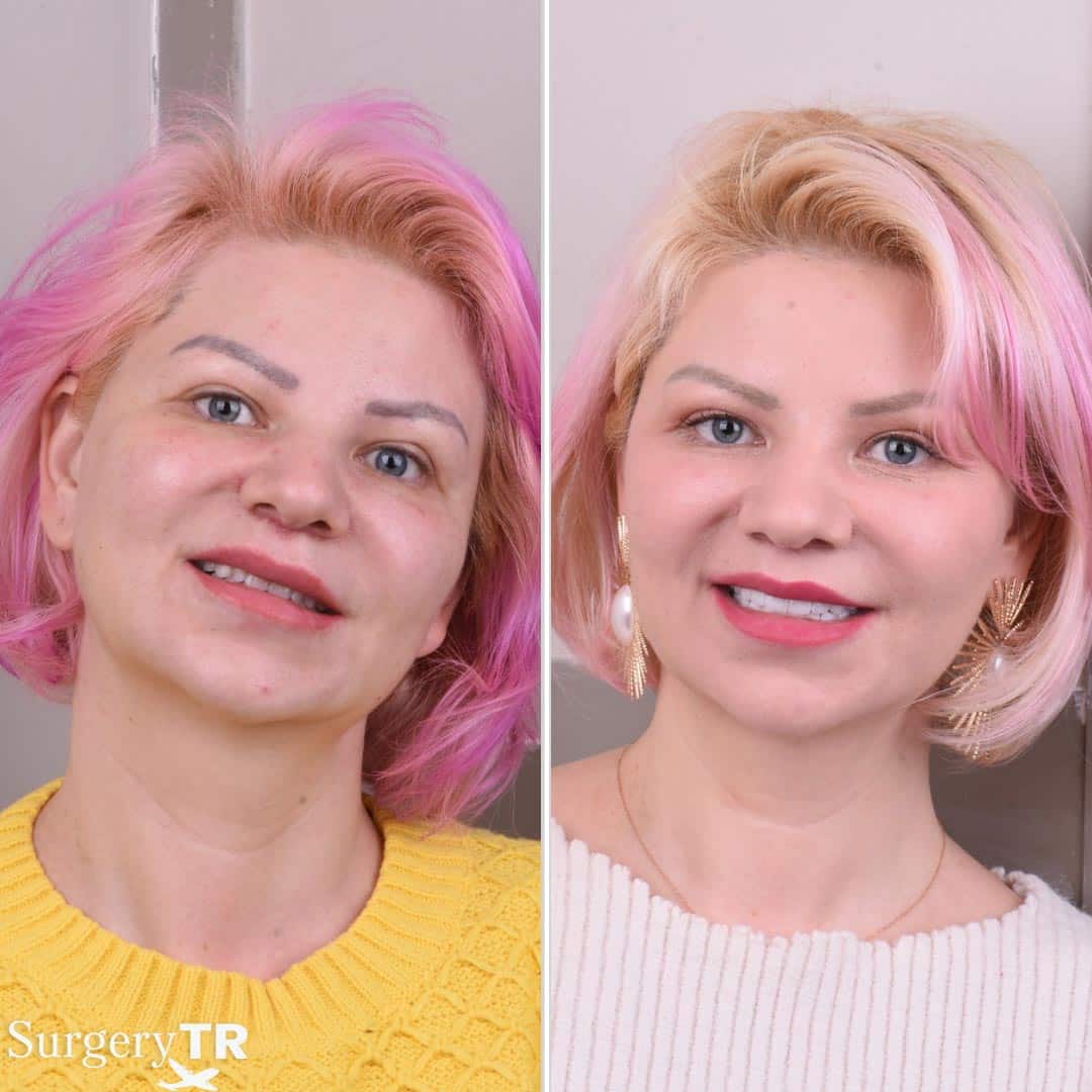 Dental Before After 3