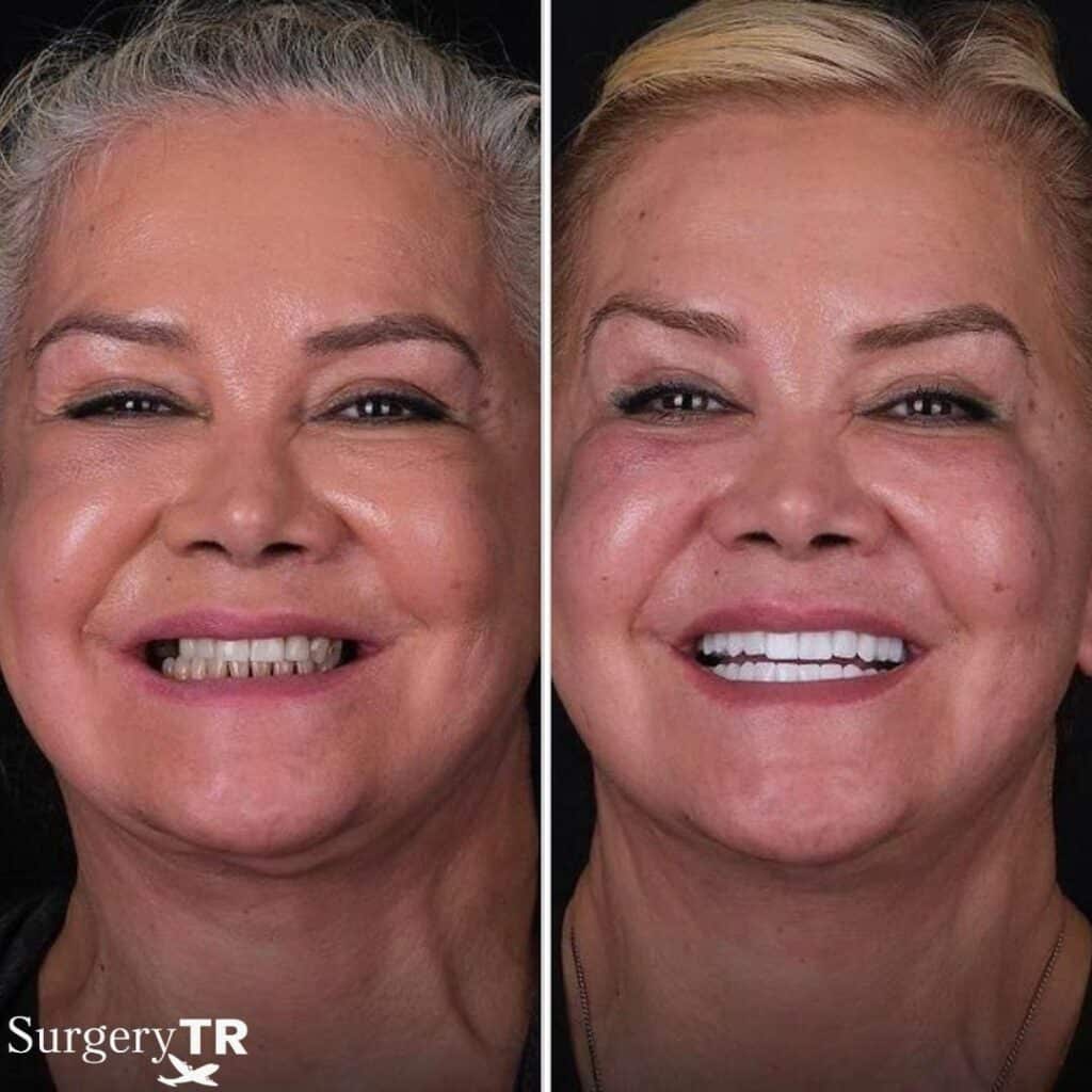 Dental Before After 5