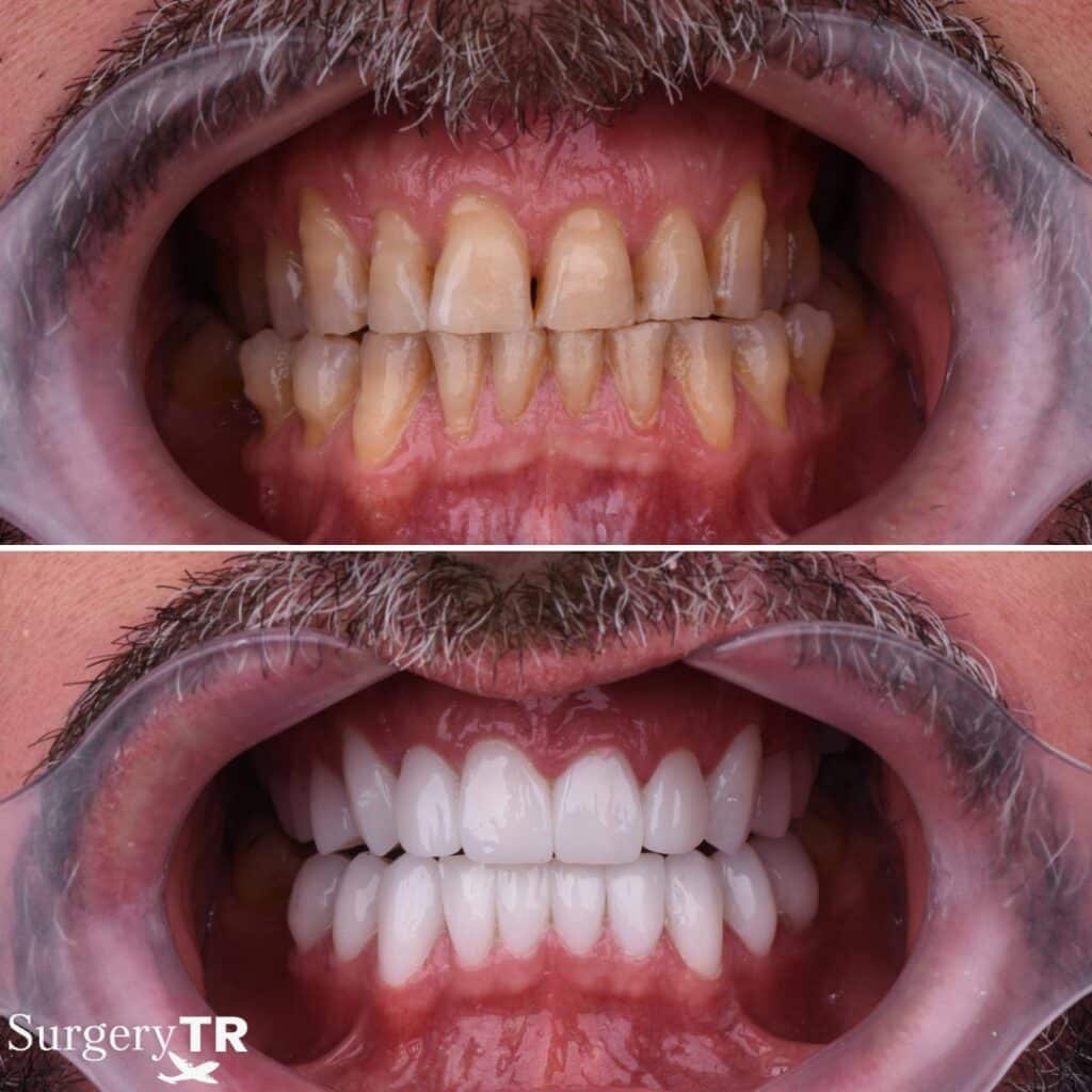 Dental Before After 8