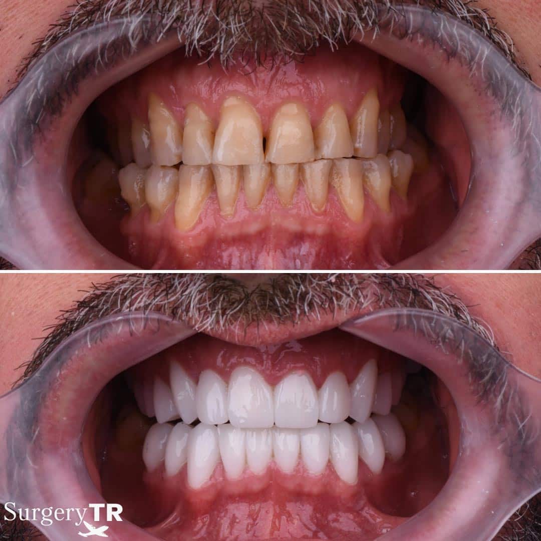 Dental Before After 8