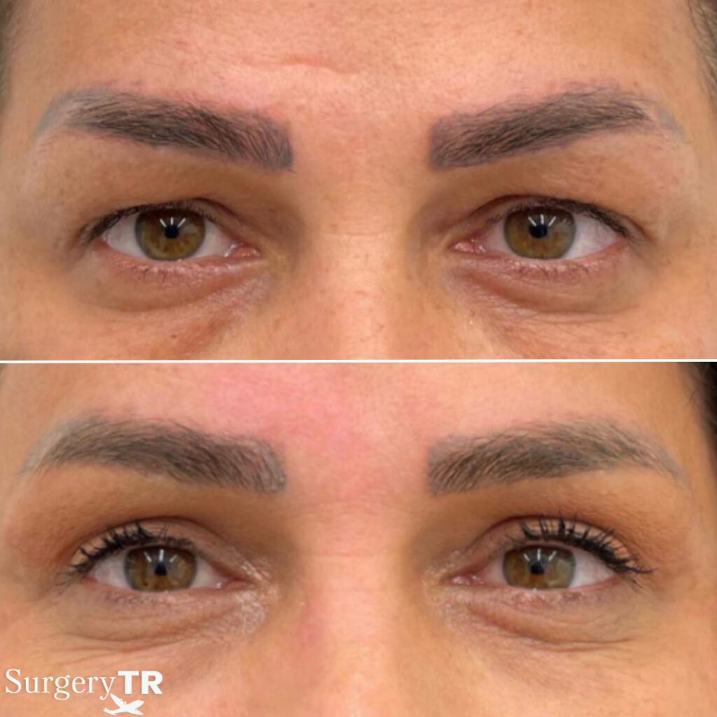 EyelidSurgery Before After 1