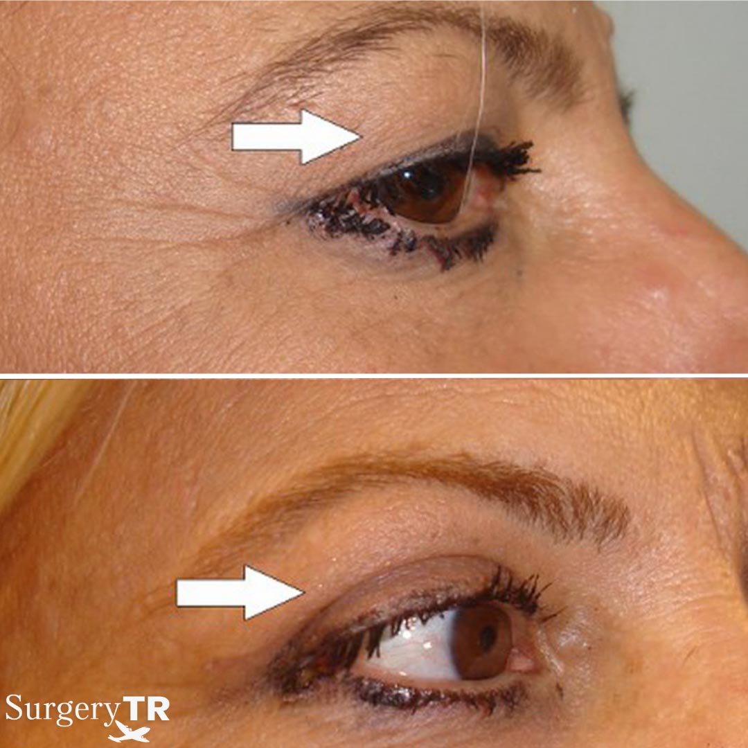 EyelidSurgery Before After 2
