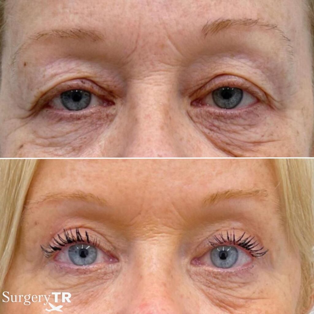 EyelidSurgery Before After 3