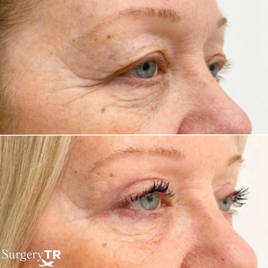 EyelidSurgery Before After 4