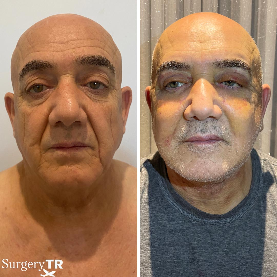 FaceLift BeforeAfter 1