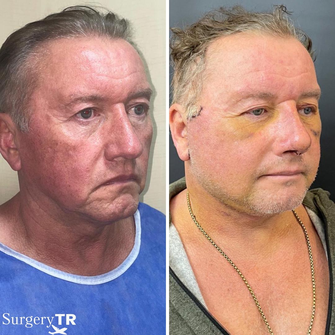 FaceLift BeforeAfter 2