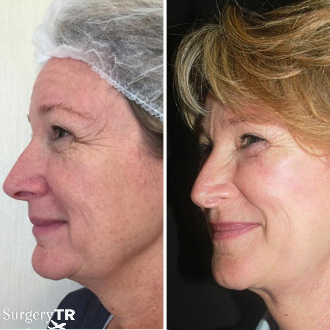 FaceLift BeforeAfter 3
