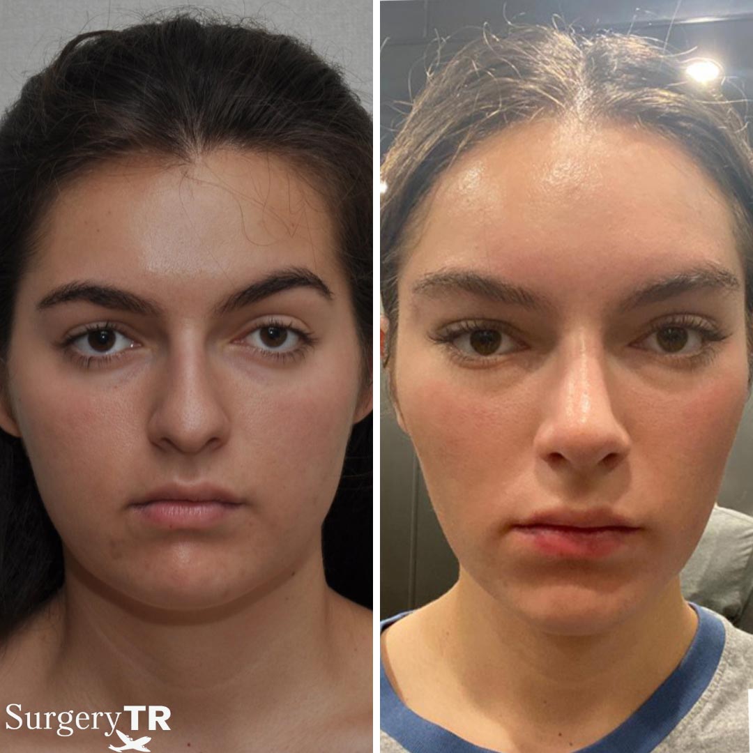 FaceLift BeforeAfter 4