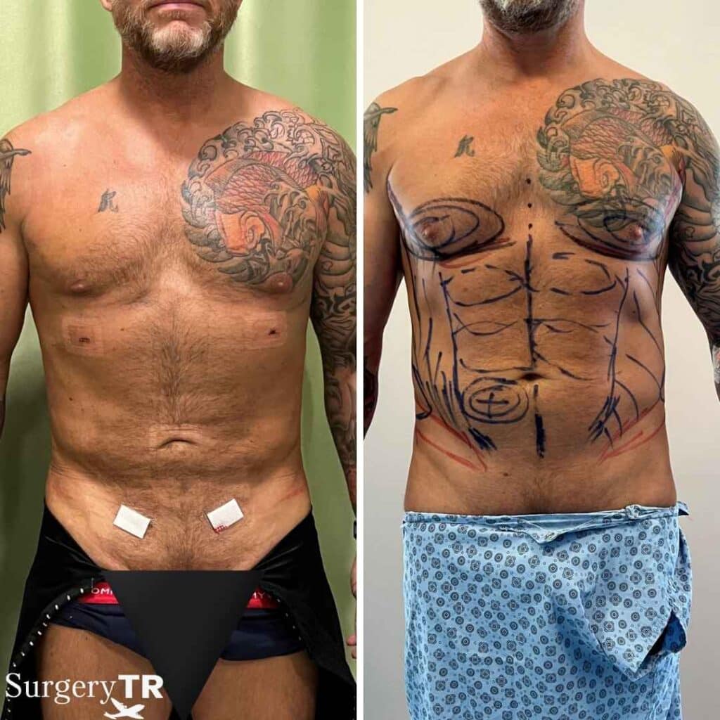 Gino Before AFter 1