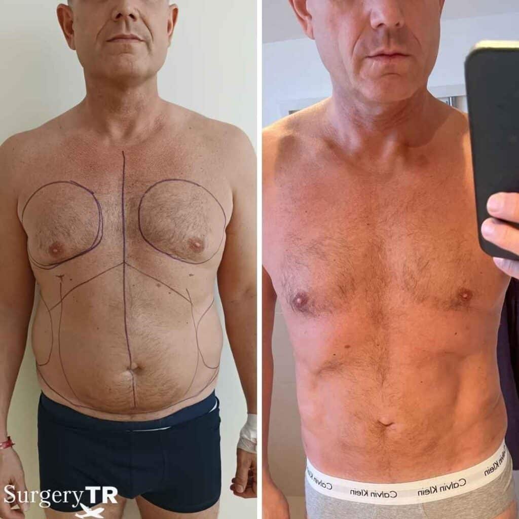 Gino Before AFter 2