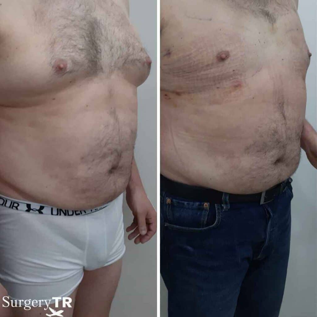 Gino Before AFter 4