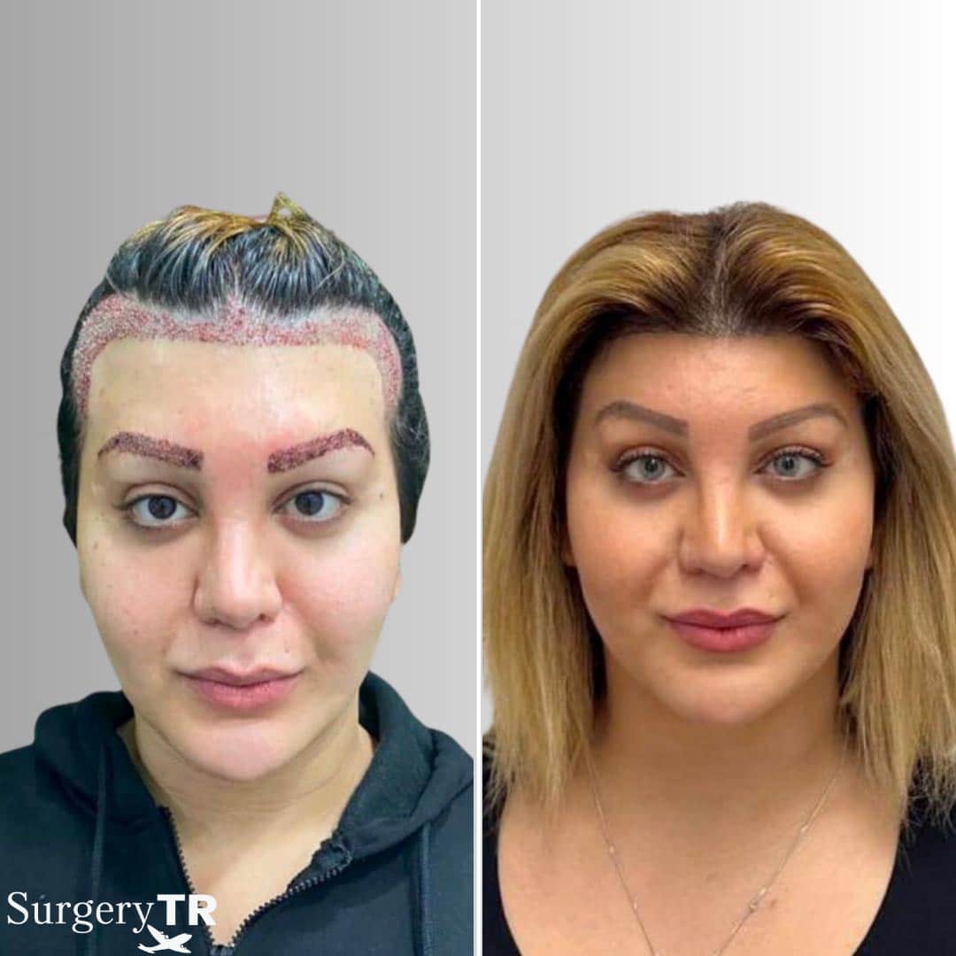 HairTransplant Before After 1