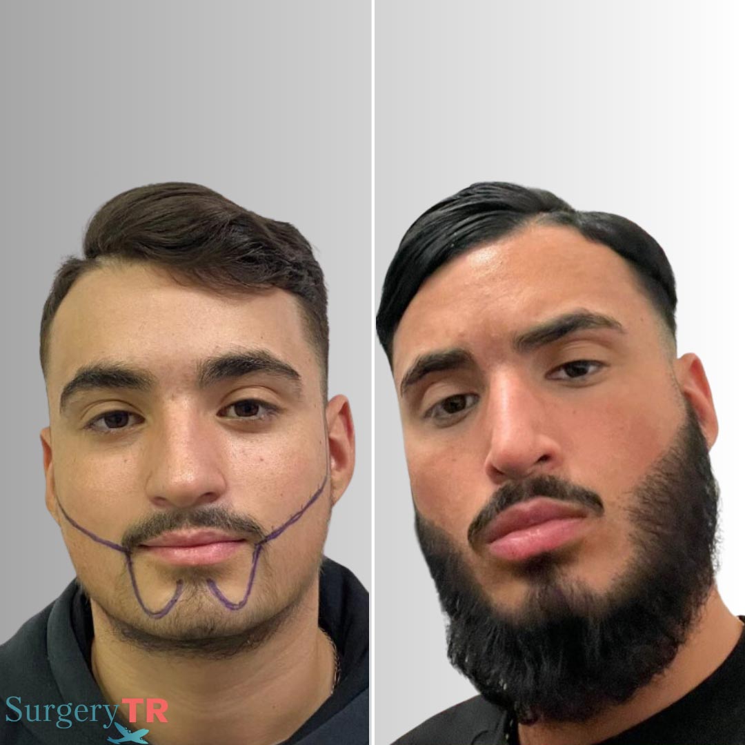 HairTransplant Before After 10
