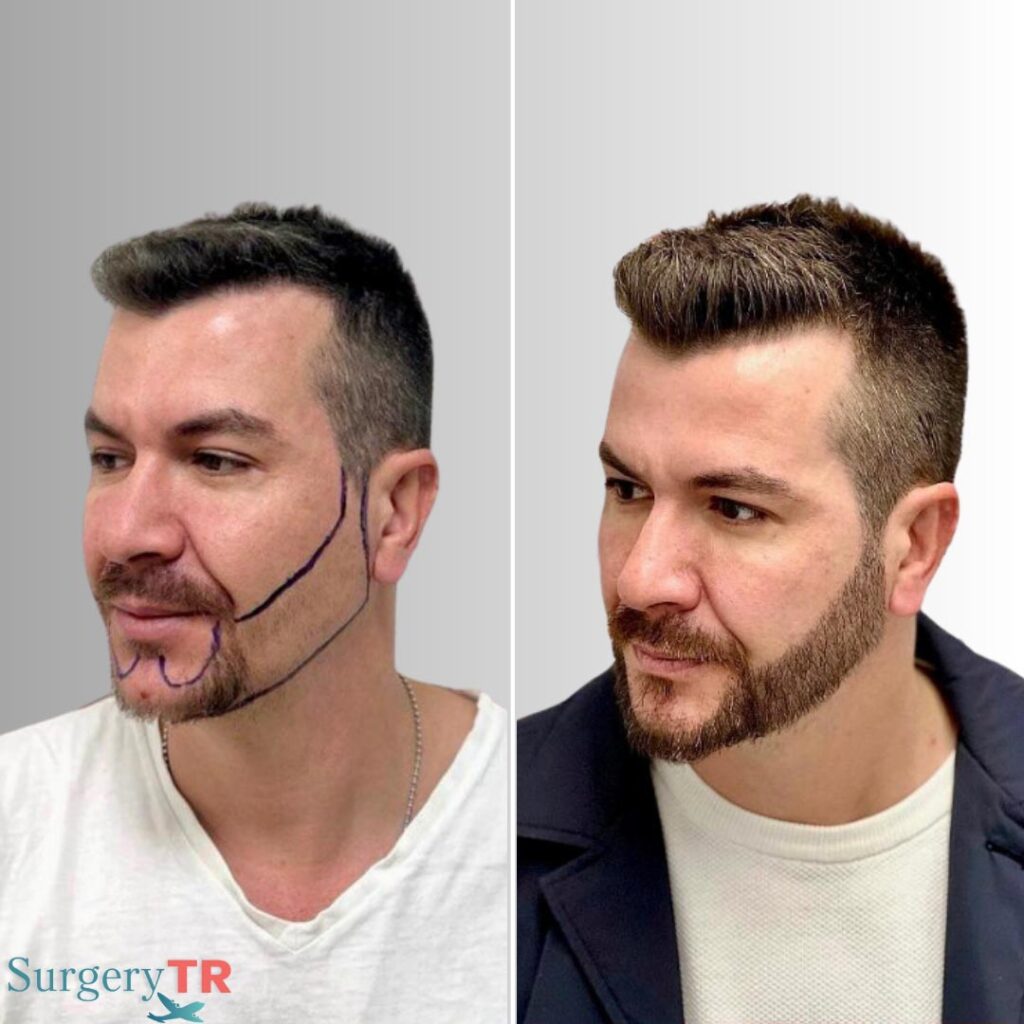 HairTransplant Before After 11