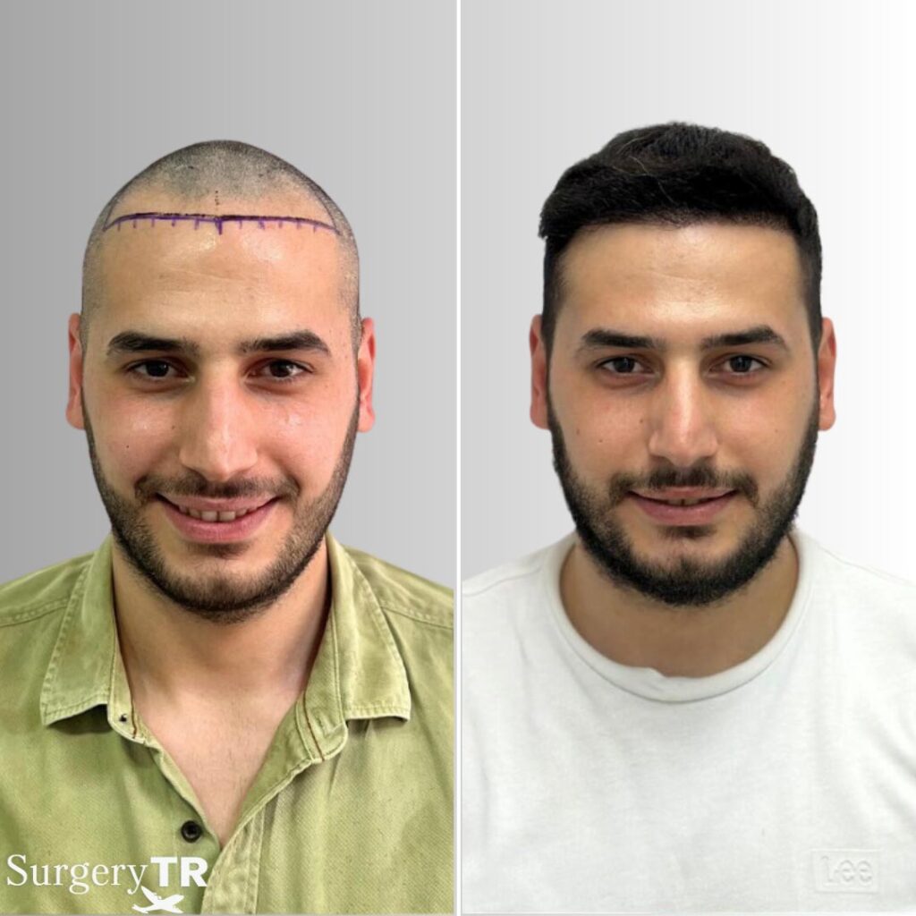 HairTransplant Before After 12