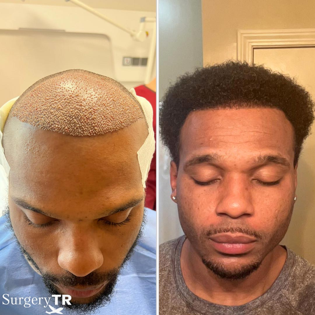 HairTransplant-Before-After-2.jpg
