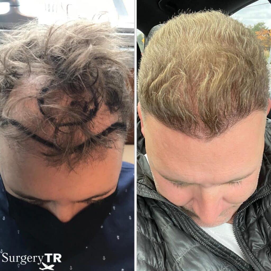 HairTransplant Before After 3
