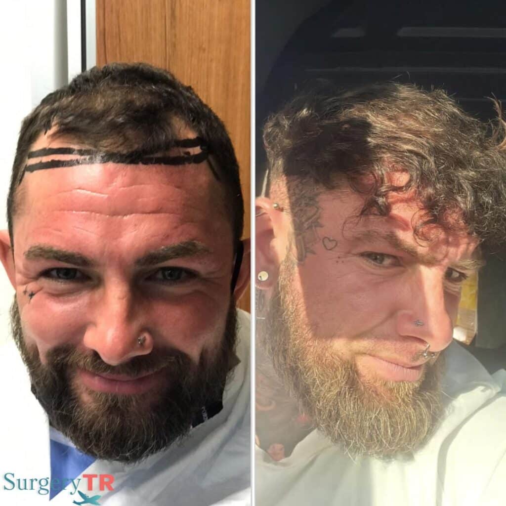 HairTransplant Before After 4