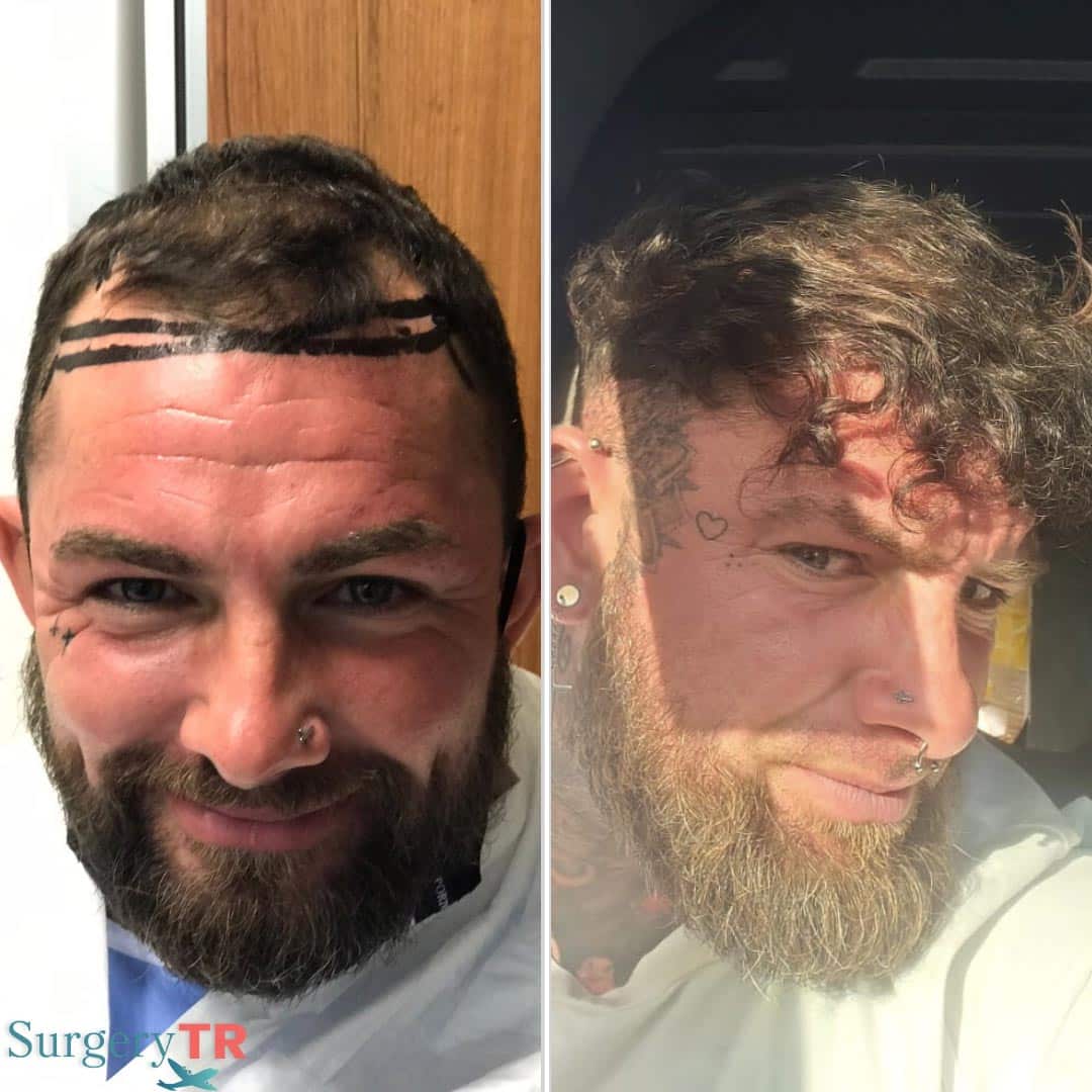 HairTransplant Before After 4