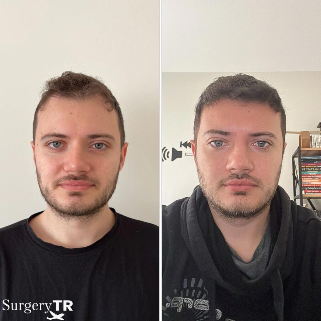HairTransplant Before After 5