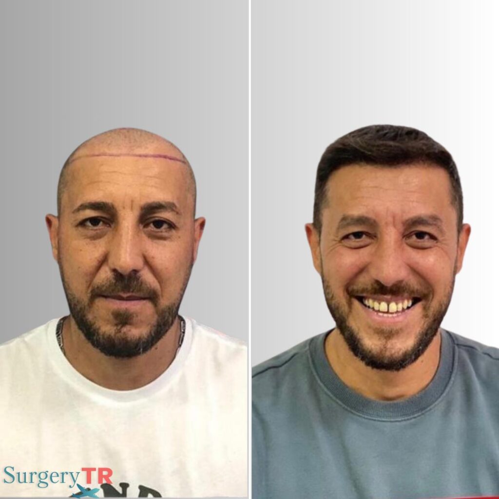 HairTransplant Before After 6