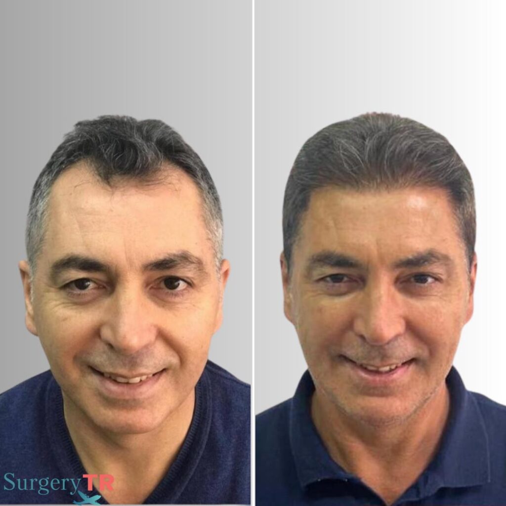HairTransplant Before After 7