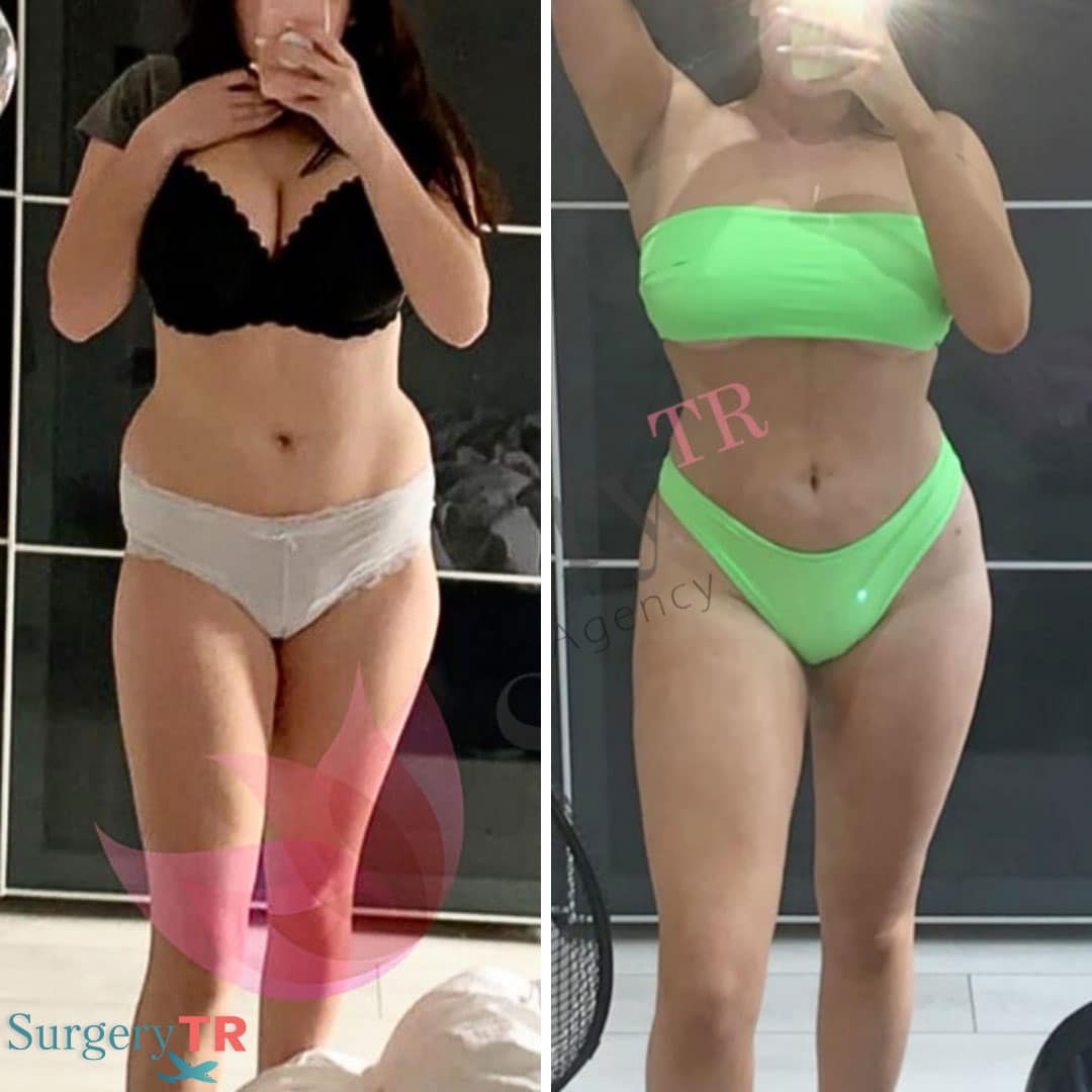Liposuction BeforeAfter2
