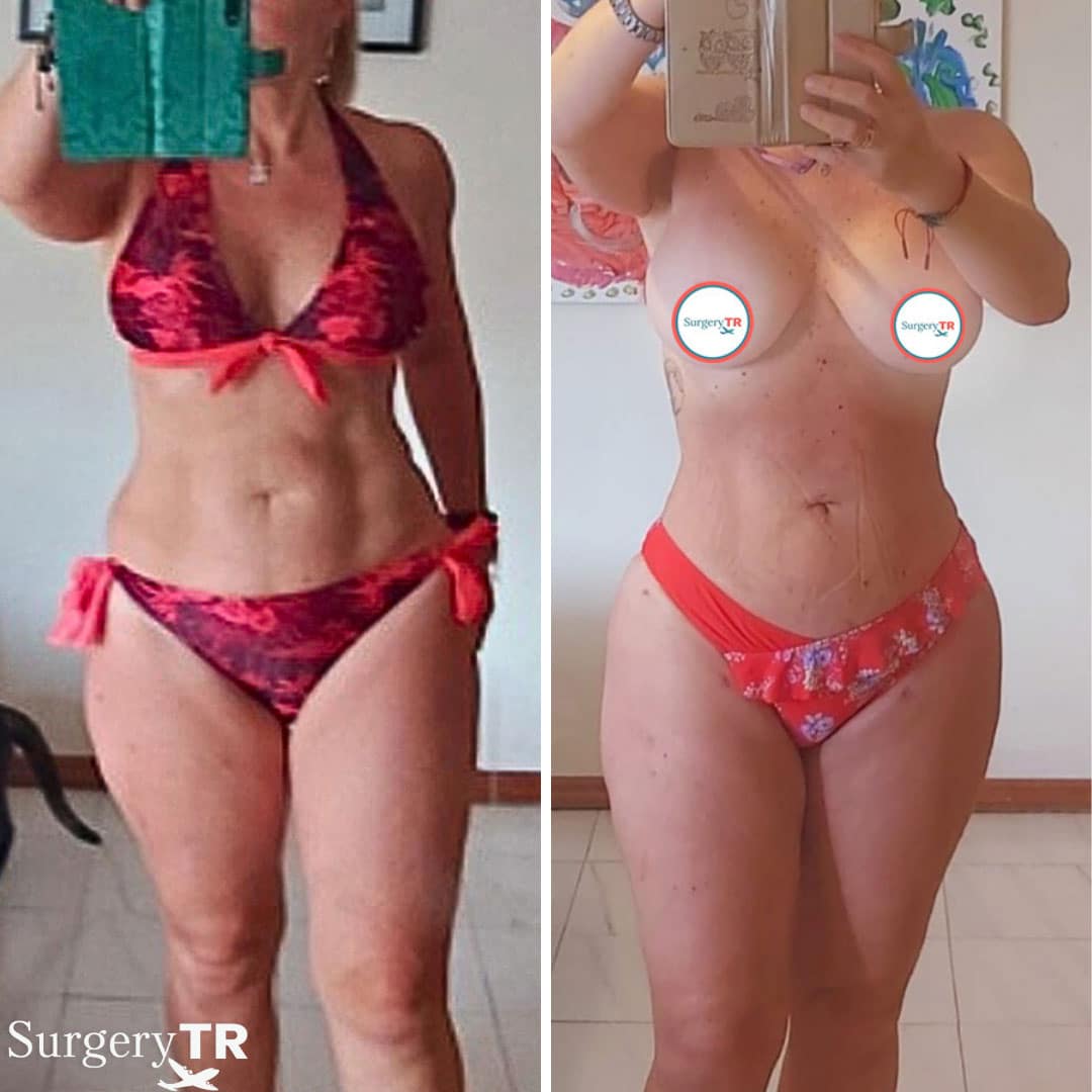 Liposuction BeforeAfter3
