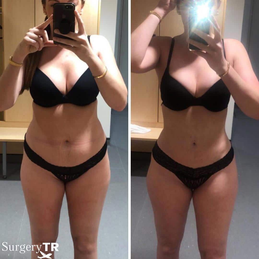 Liposuction BeforeAfter4