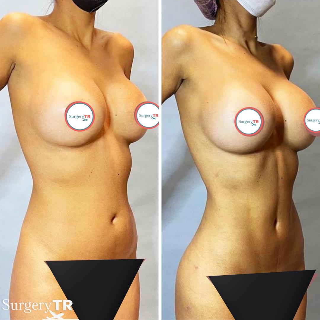Liposuction BeforeAfter5