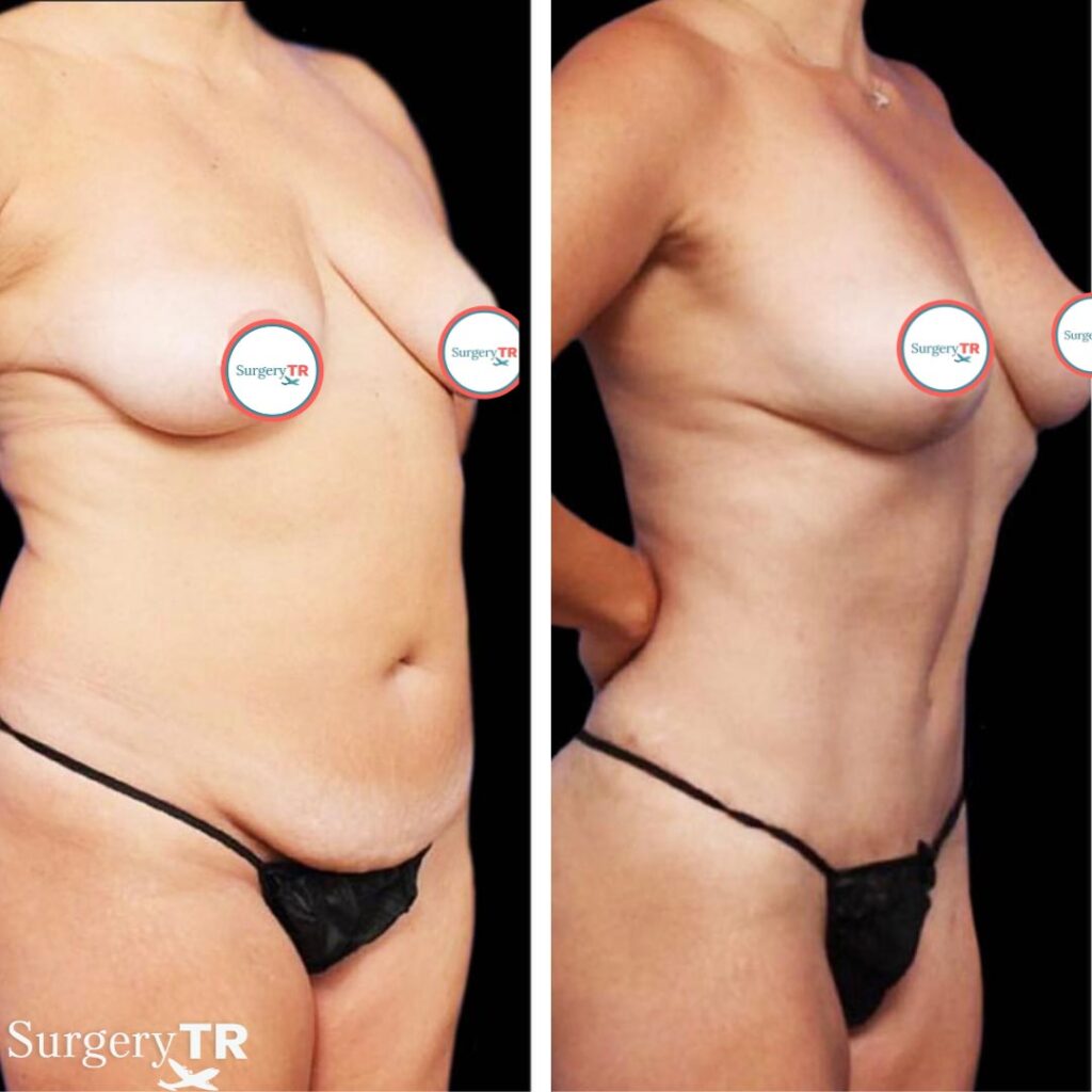 Liposuction BeforeAfter6