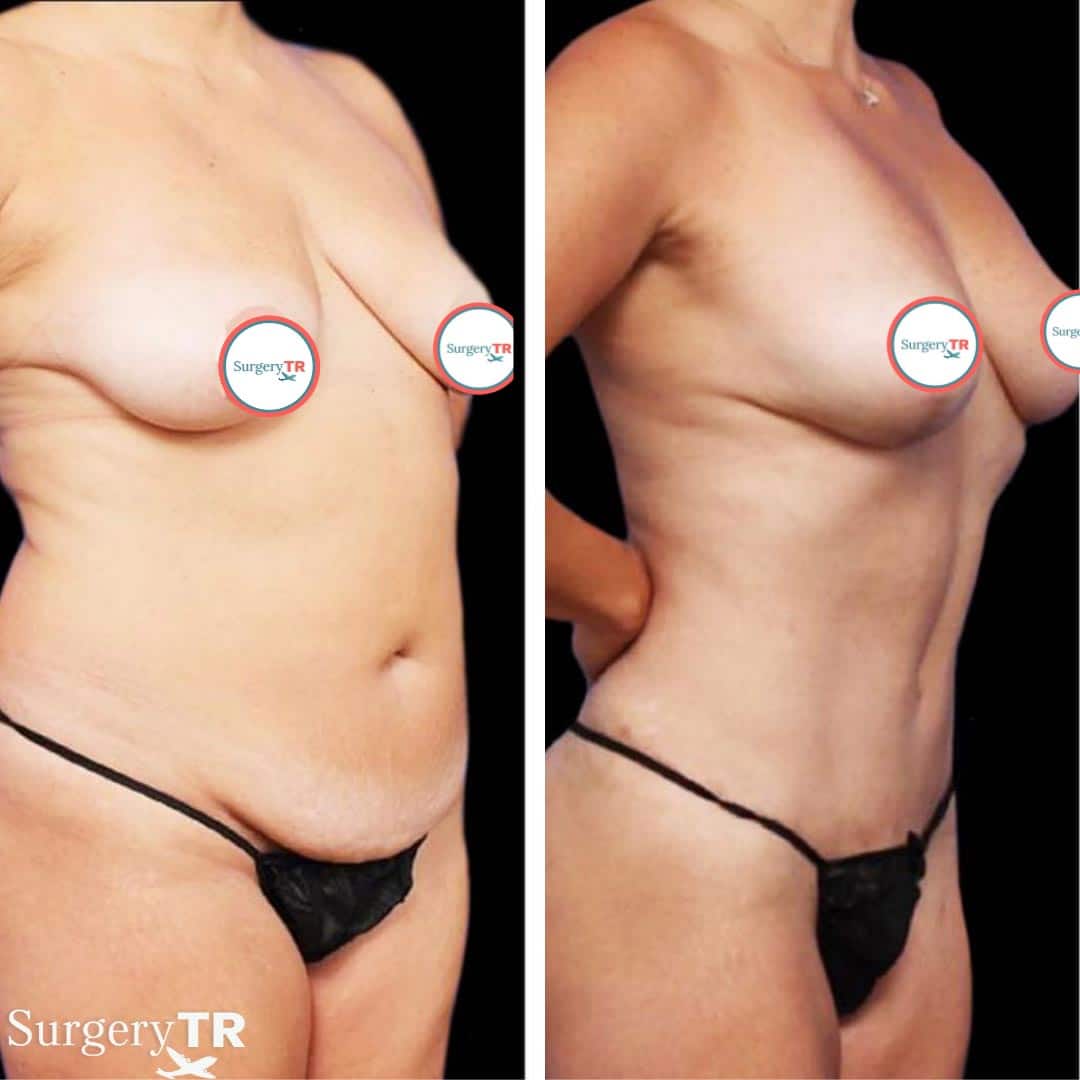 Liposuction BeforeAfter6