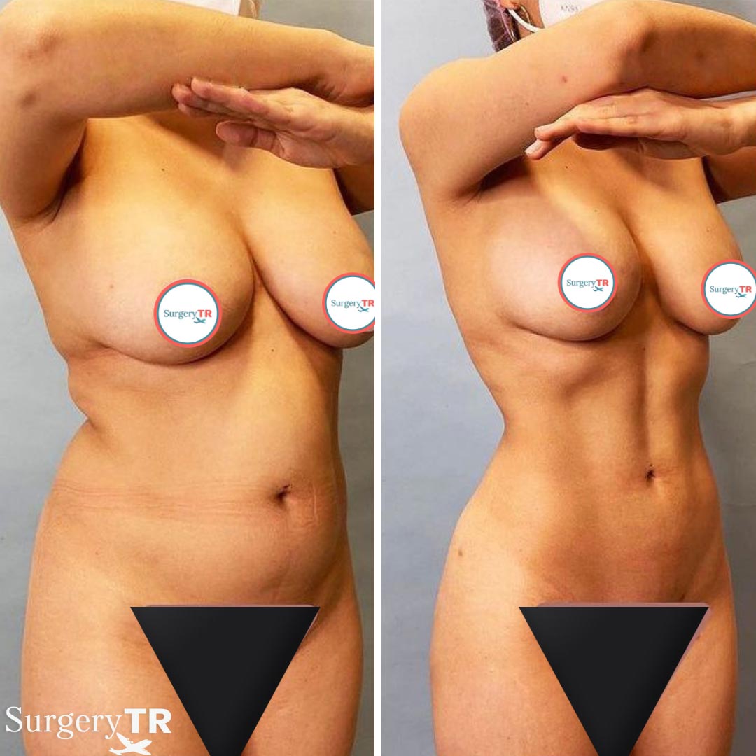 Liposuction BeforeAfter7