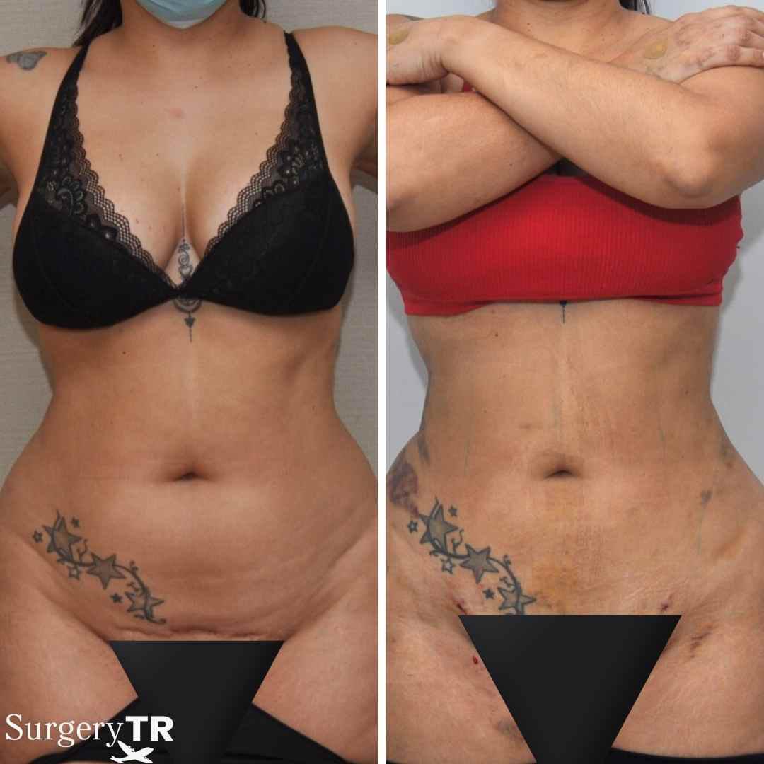 Liposuction BeforeAfter8