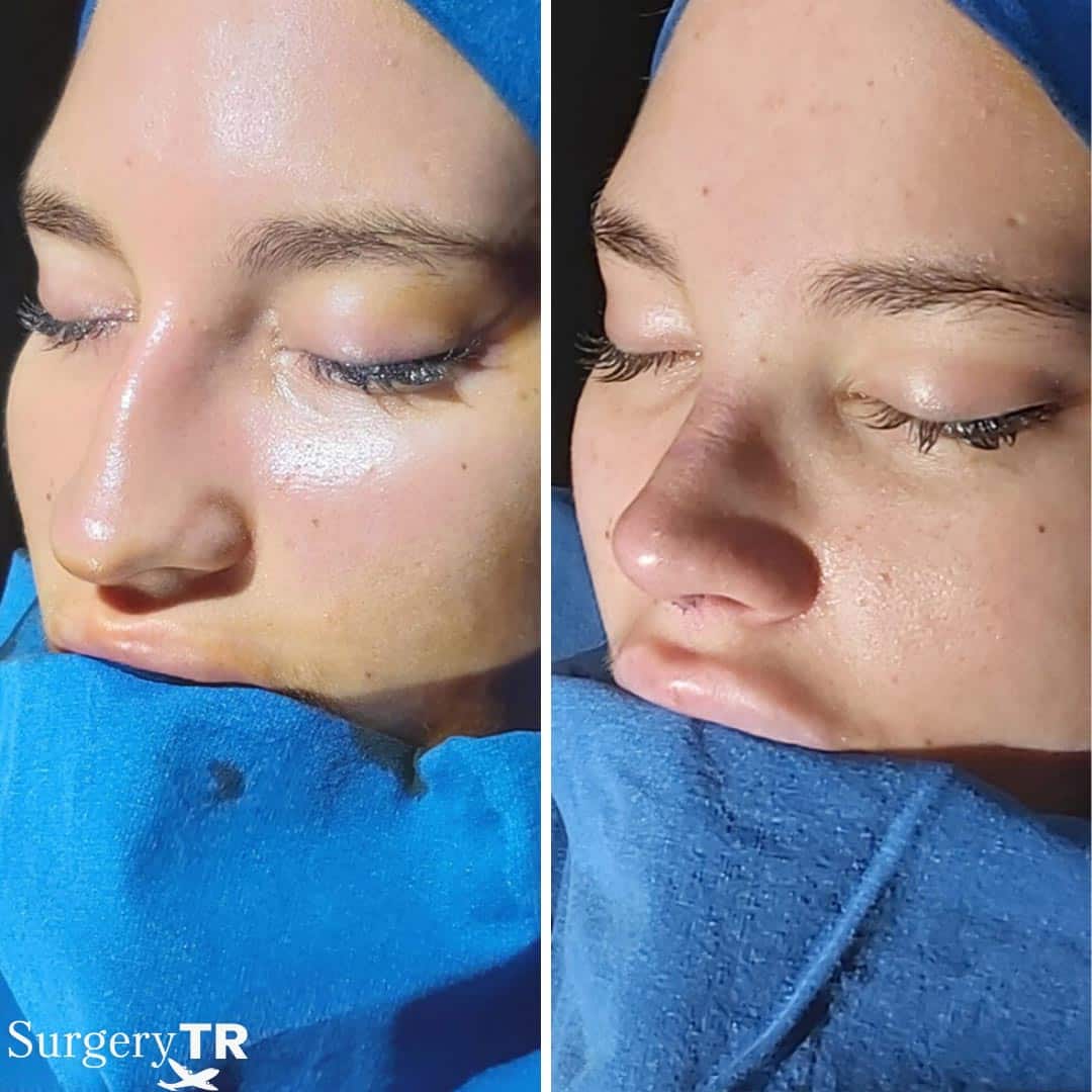 RhinoplastyBeforeAfter 1