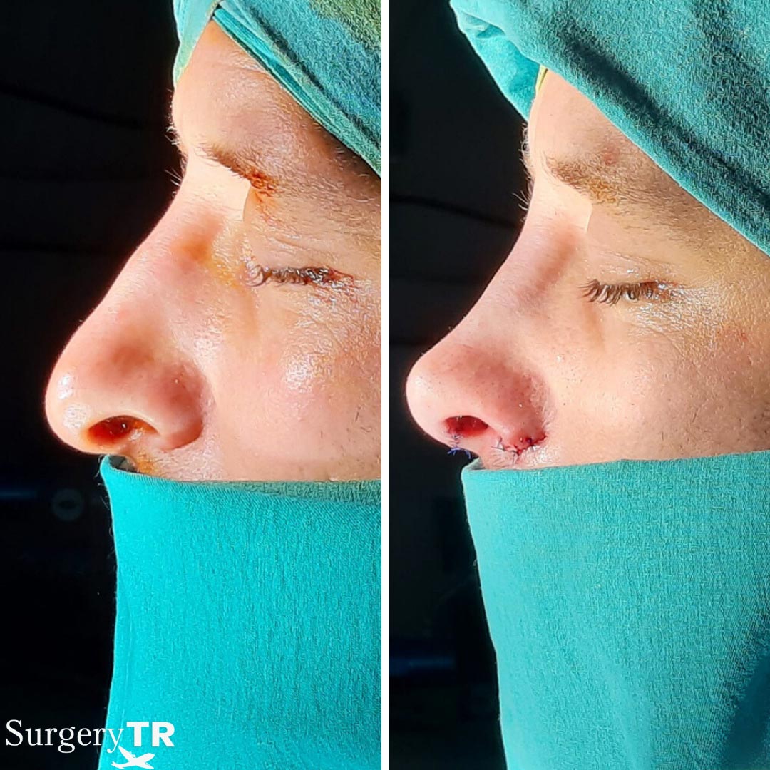 RhinoplastyBeforeAfter 2