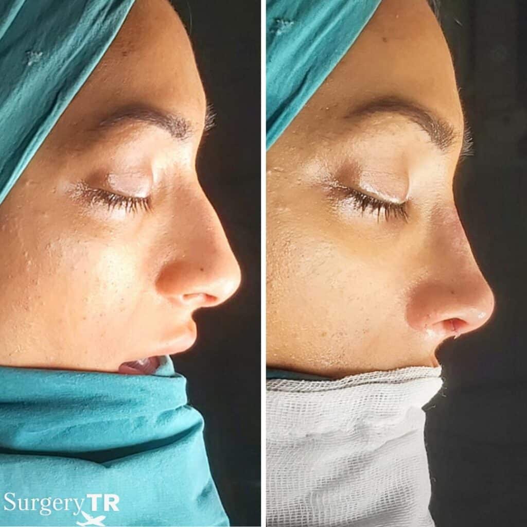 RhinoplastyBeforeAfter 3