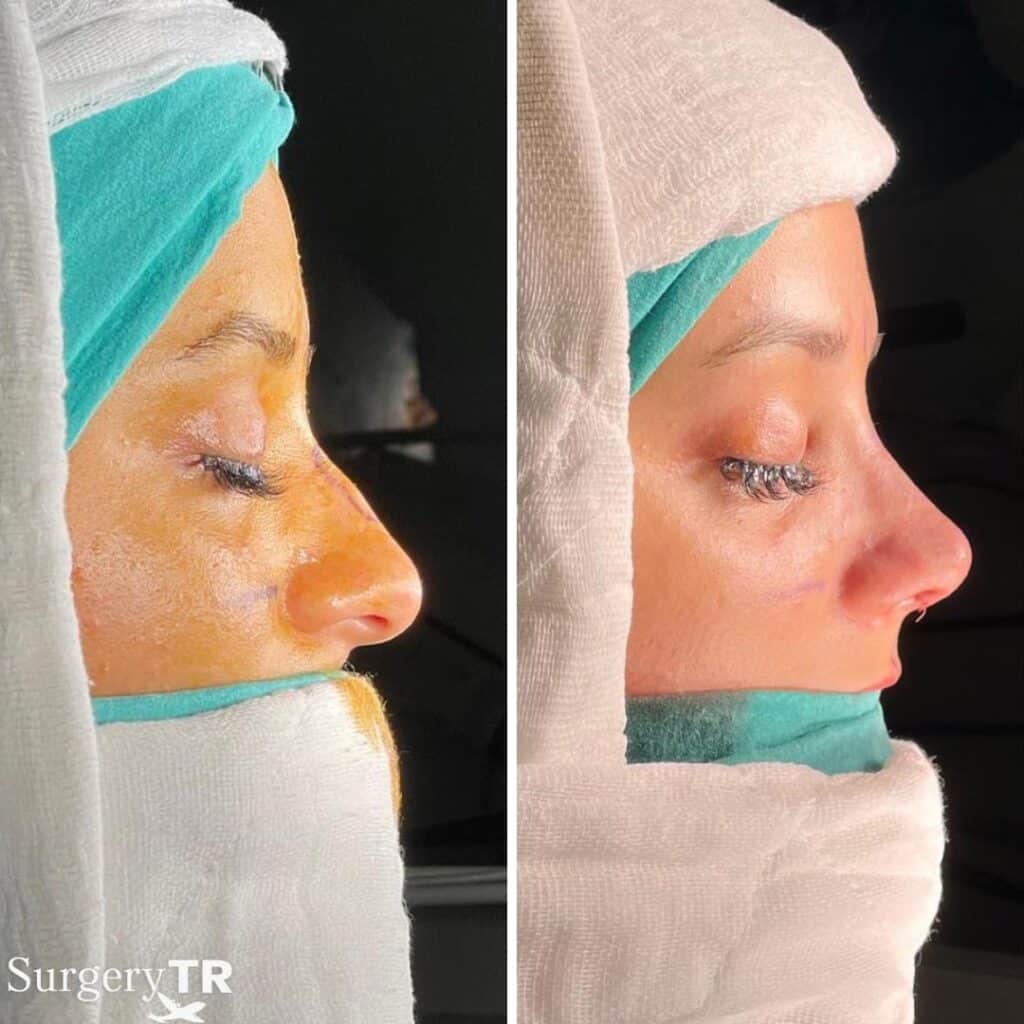 RhinoplastyBeforeAfter 4