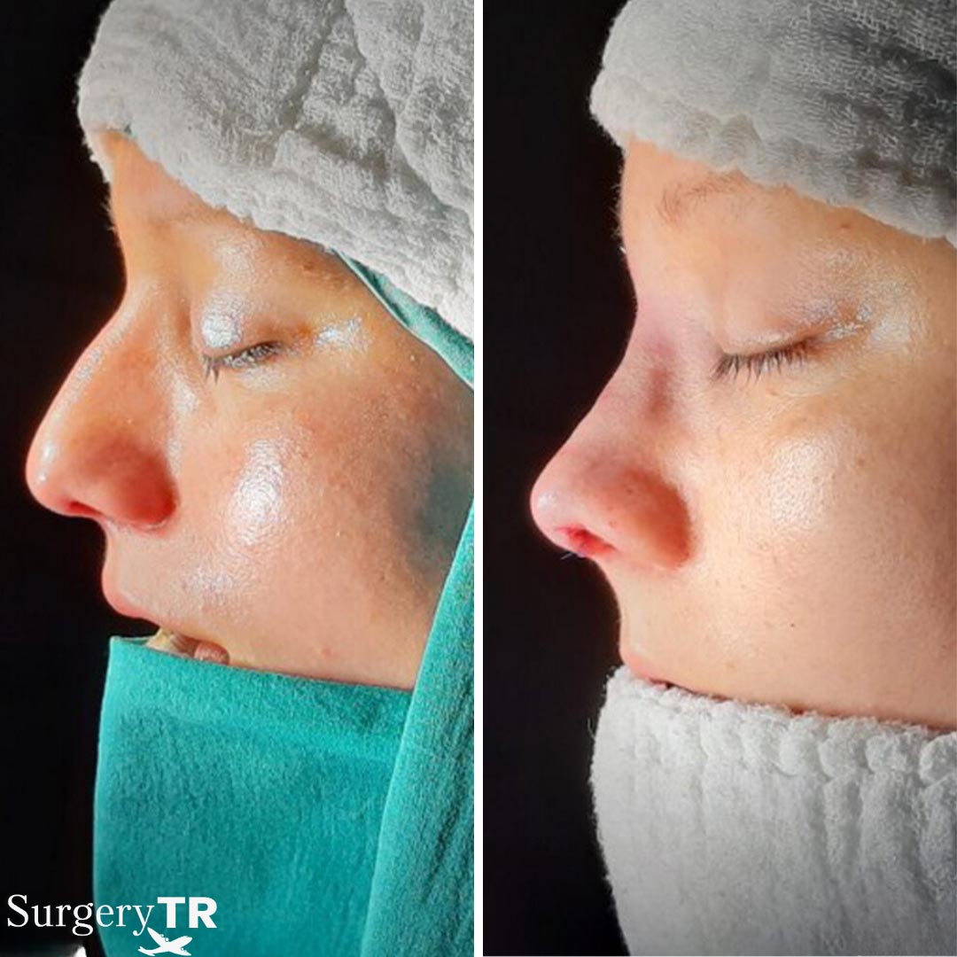 RhinoplastyBeforeAfter 5