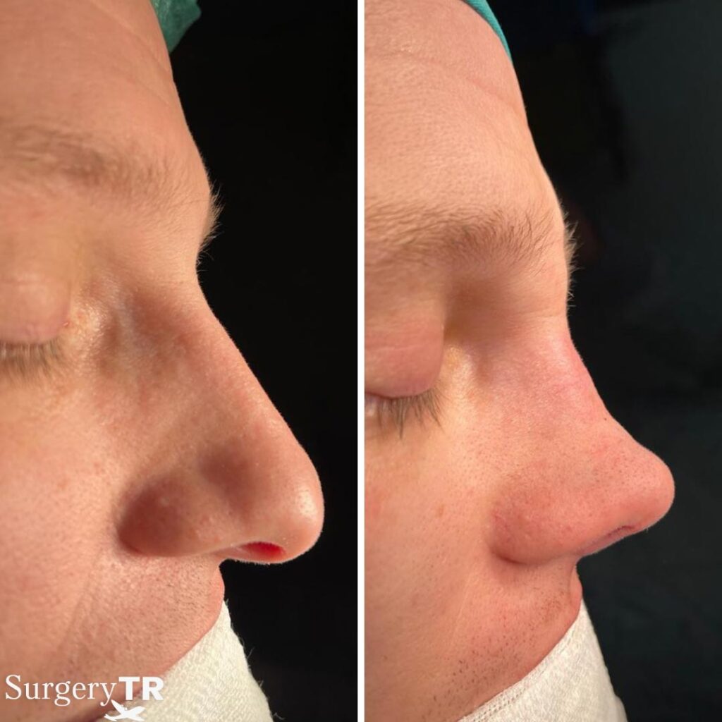 RhinoplastyBeforeAfter 6