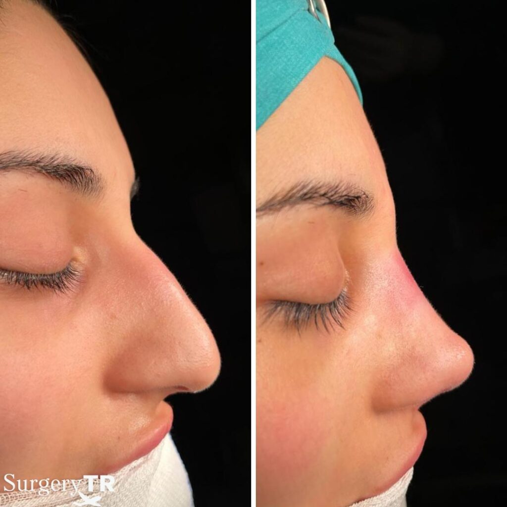 RhinoplastyBeforeAfter 7
