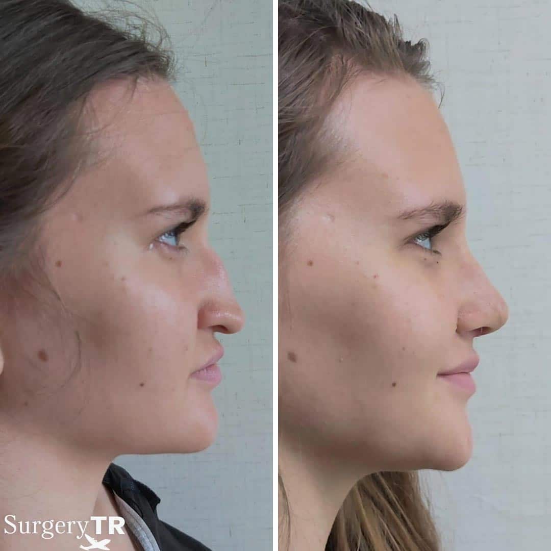 RhinoplastyBeforeAfter 8