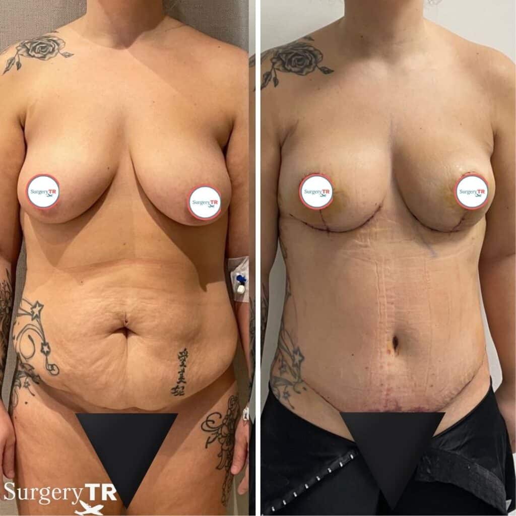 TummyTuck BeforeAfter 1 1