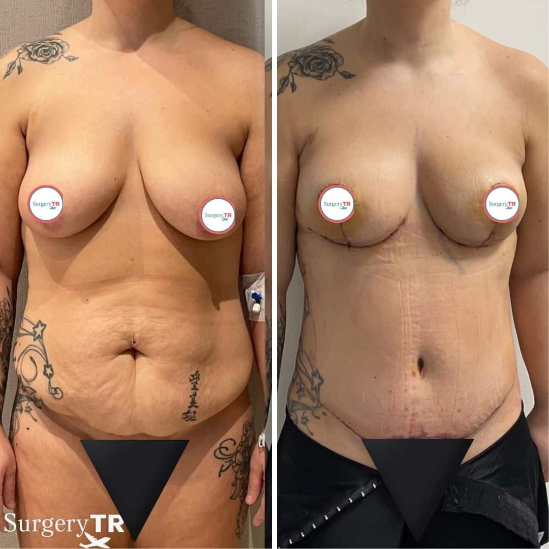 TummyTuck BeforeAfter 1 1