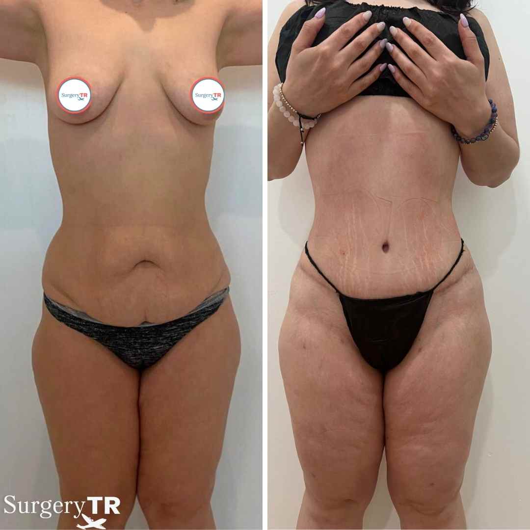 TummyTuck BeforeAfter 1 2